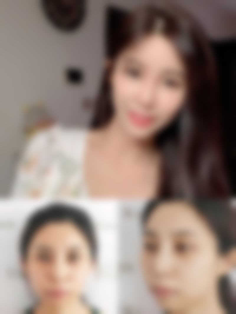 烧伤疤痕可以完全去掉吗？了解多种治疗方法及效果，附真实图片参考 