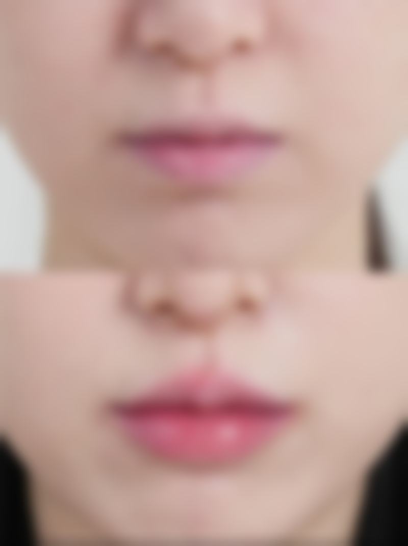 二、影响自体脂肪隆胸维持时间的关键因素