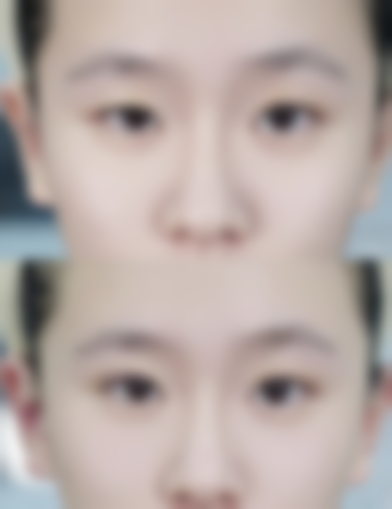 黄瓜胶能去眼袋吗？权威解析其效果及对不同成因眼袋的作用 