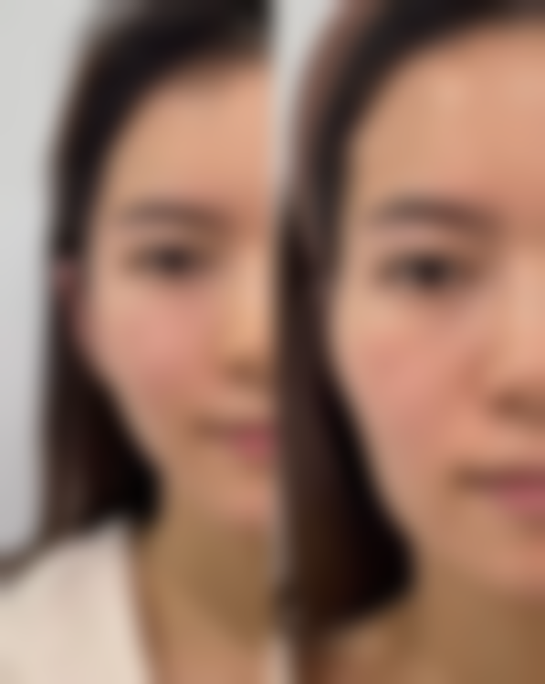 六、开水烫伤疤痕祛除的注意事项