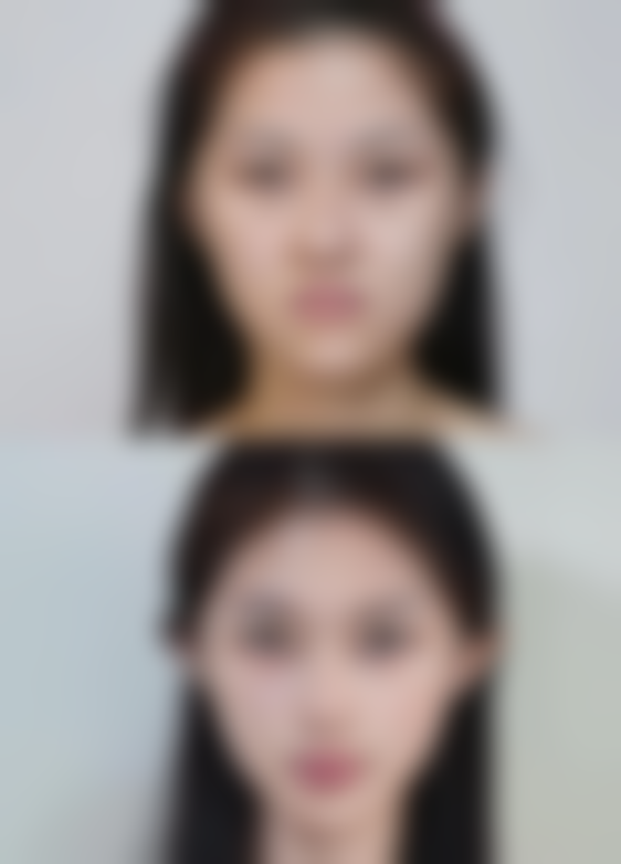 眼袋上面有小疙瘩是怎么搞的？原因可能有脂肪粒、汗管瘤或毛囊角化等！ 