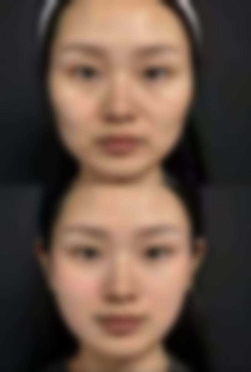 二、抽脂消除富贵包的可行性