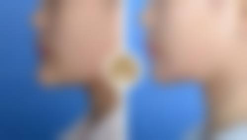 三、去除重度黑眼圈眼袋的医美手段