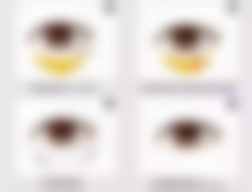 五、看眼袋黑眼圈，美容科的选择