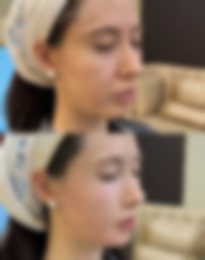 二、去除重度黑眼圈眼袋的实用小妙招