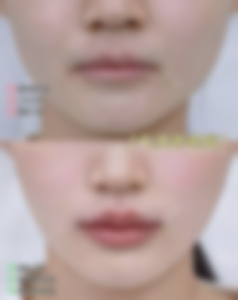 二、脸上的旧疤痕怎么去?主流改善方案大揭秘