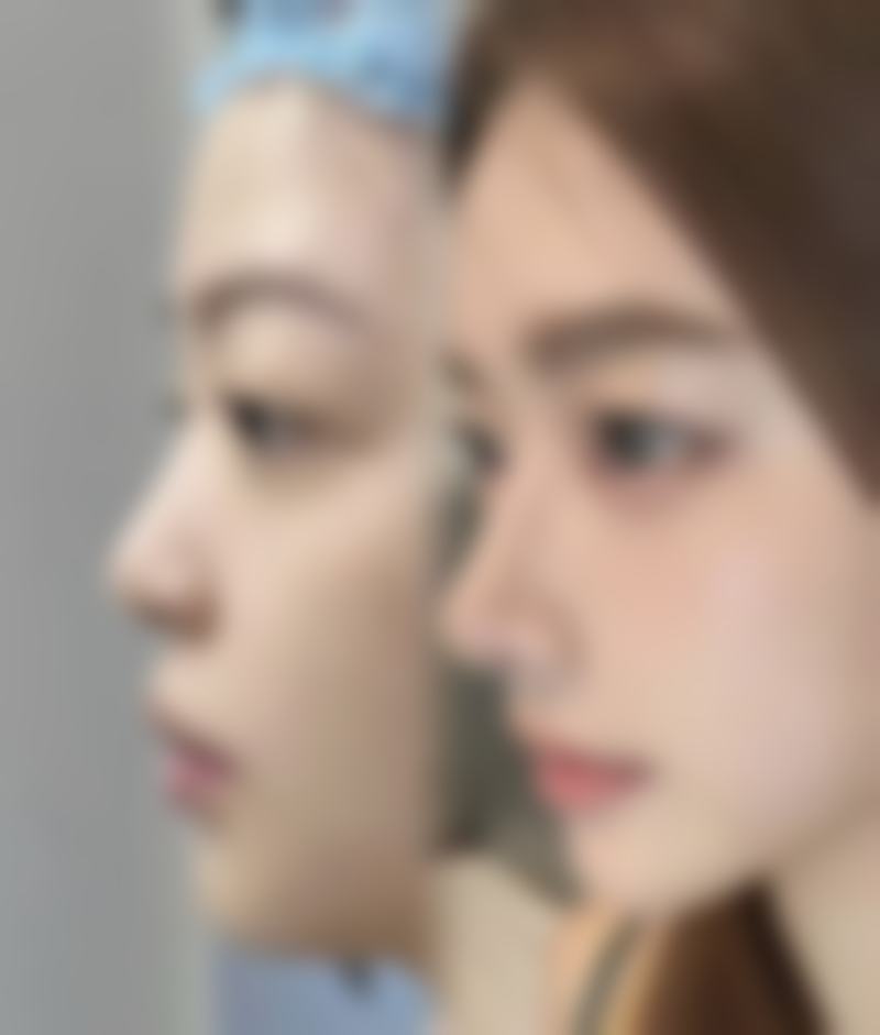 一、重度黑眼圈眼袋形成的原因