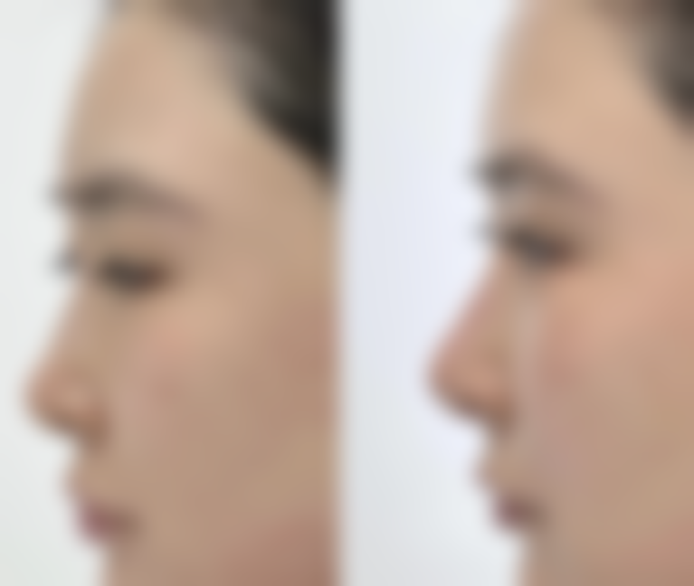 一、常见的眼袋切除后遗症有哪些