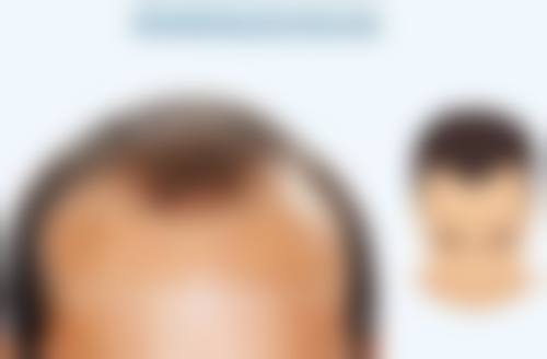 做双眼皮开眼角好吗？总结与建议