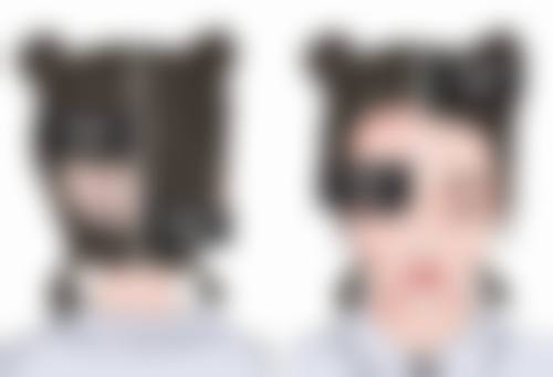 一、硅胶隆鼻穿透鼻尖的前期症状表现