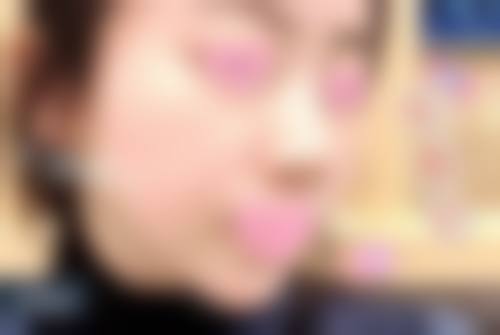 一、割双眼皮6天拆线的可能性分析