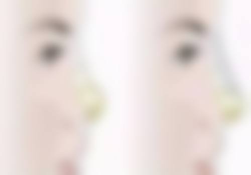 每天早睡黑眼圈和眼袋会消失吗？女生必知的眼周改善秘诀与科学应对方法 