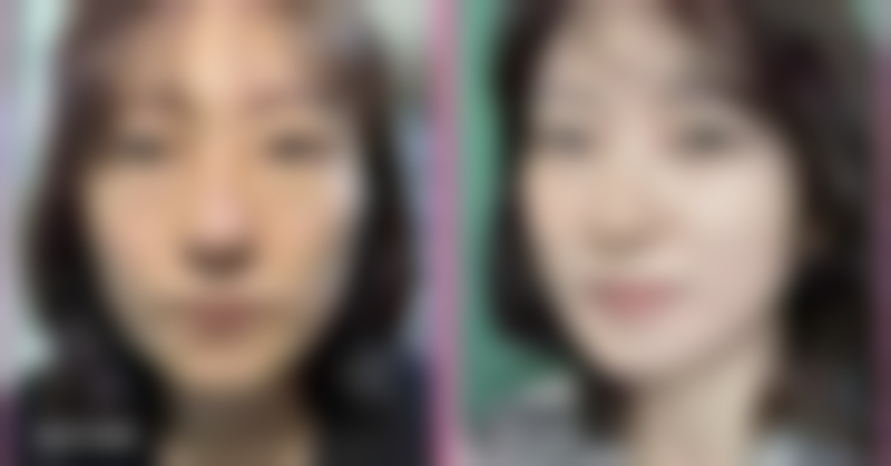 四、不同阶段脸上摔伤疤痕的治疗方案