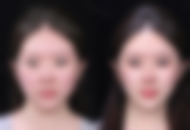 脸上摔伤的疤痕怎么办？掌握消除方法与护理要点，重获光滑肌肤不是梦！ 