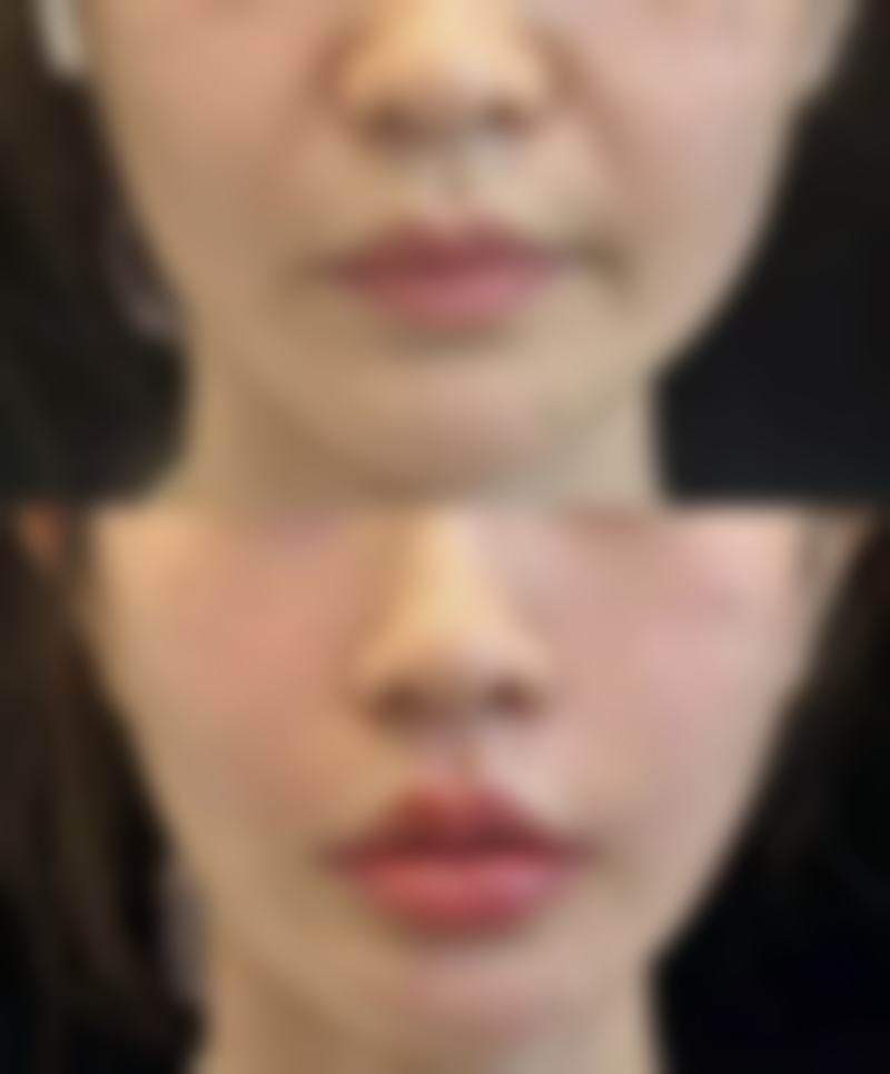 硅胶隆鼻穿透鼻尖是什么样？从症状表现到相关图片为你全面揭秘 