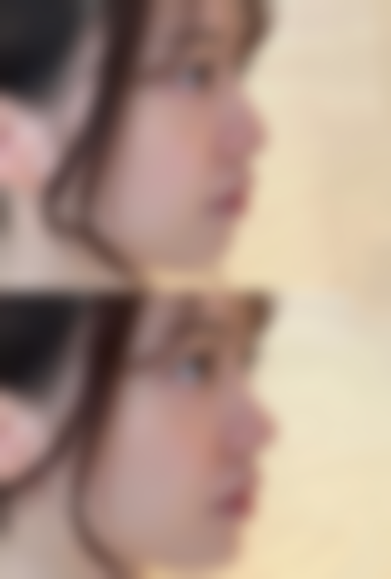 三十六岁做双眼皮效果好吗？个性化方案与精细操作助女性实现自然年轻化之美 