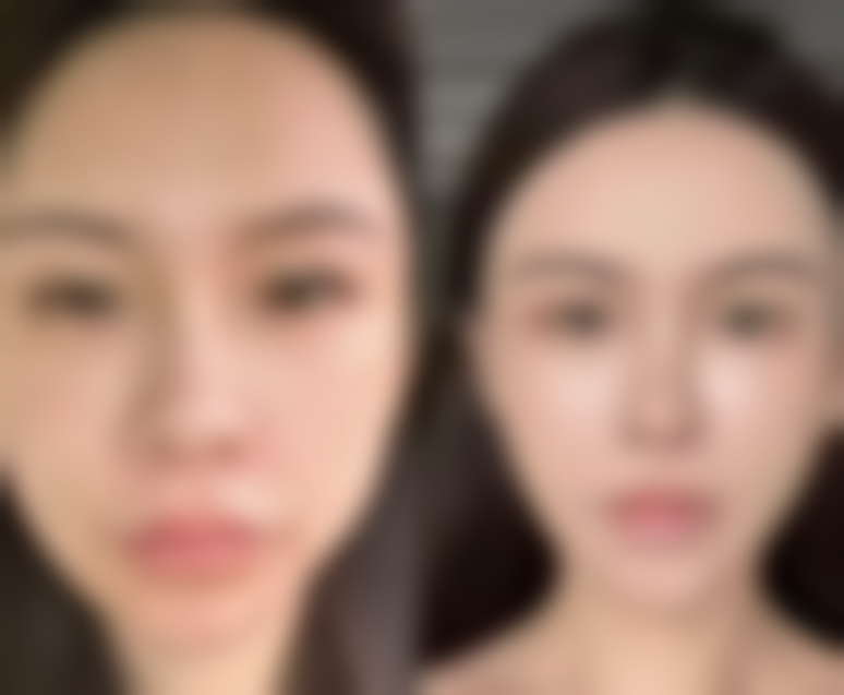 七、上海德琳医疗美容医院相俊医生男性增粗项目的术后护理