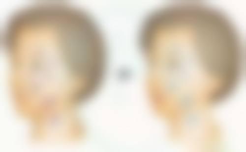 二、疤痕状态也影响是否需要按摩