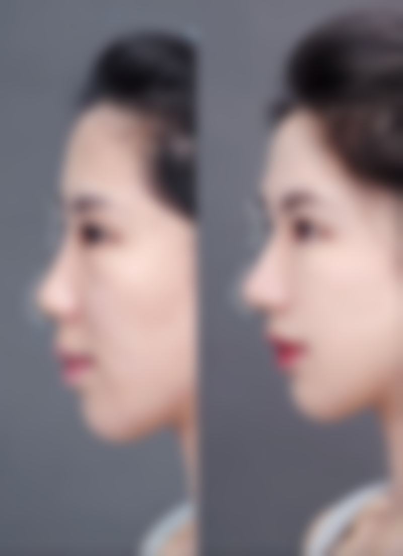 瘦脸针脸下垂怎么办？