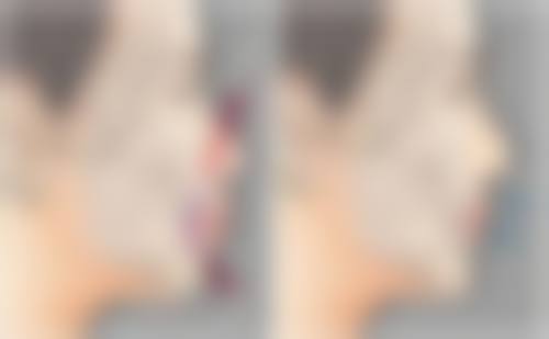 四、如何选择适合自己的韩国瘦脸针品牌