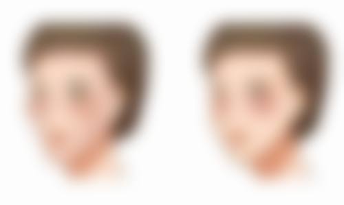 一、菠萝对双眼皮术后修复的影响