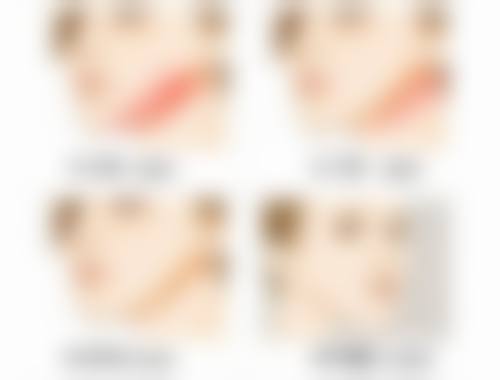 一、激光治疗点痣增生疤痕一次能好吗