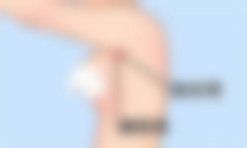 三、激光治疗点痣增生疤痕的原理