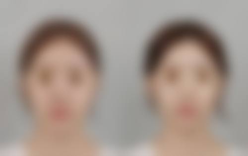 做眼袋手术有生命危险吗？了解手术费用与安全要点让你安心变美