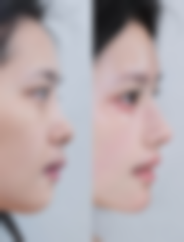 一、做眼袋手术的基本情况