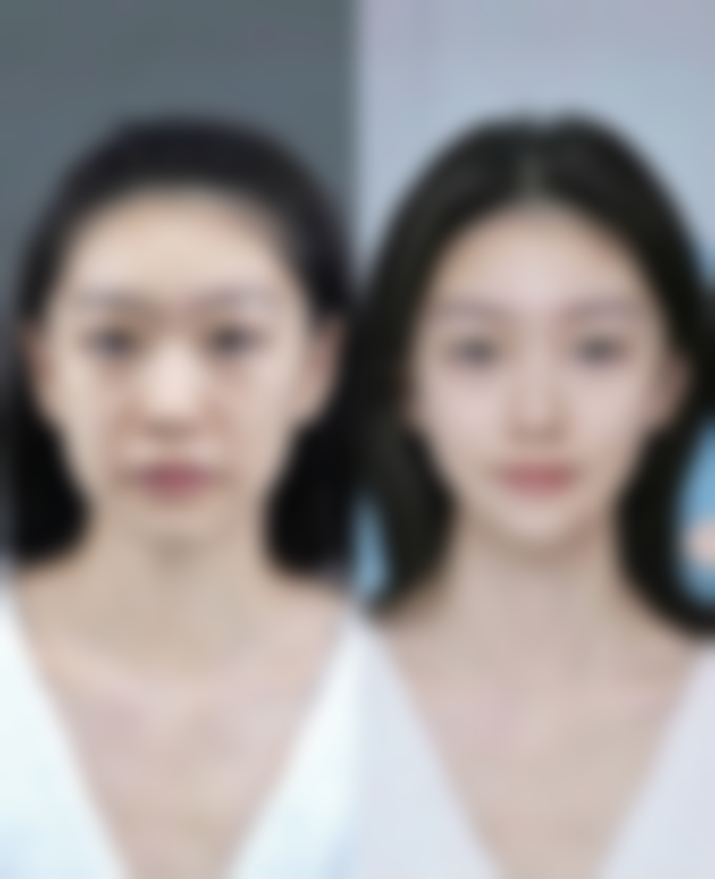 四、儿童脸上疤痕怎么办:特殊疤痕的应对