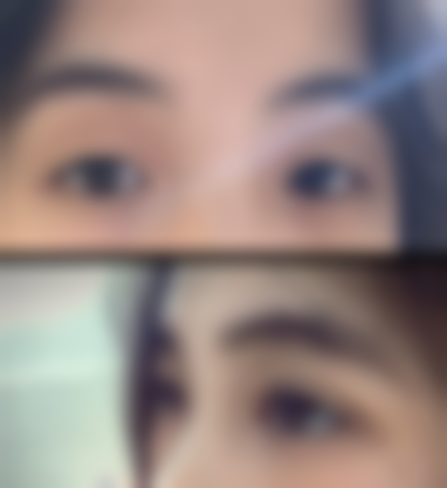 一、什么是疤痕疙瘩？