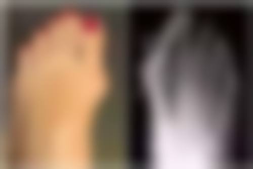 二、影响抽脂完修复时间的因素