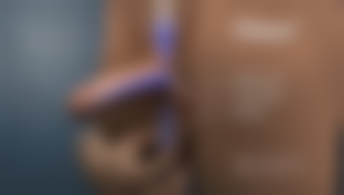 三、抽脂完修复期间的美学护理建议