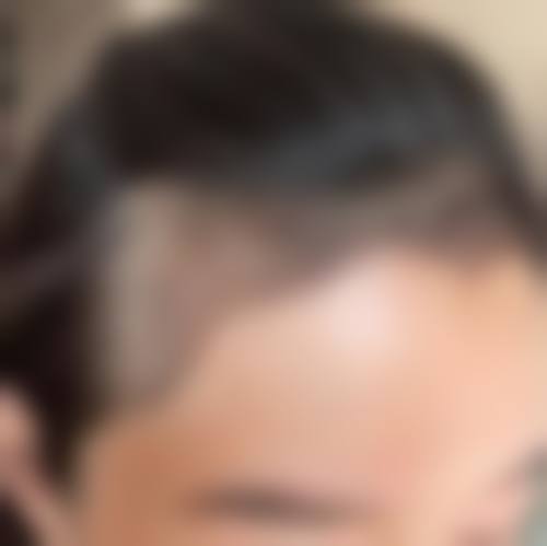 四、重庆李梅博士植发中 心特色项目