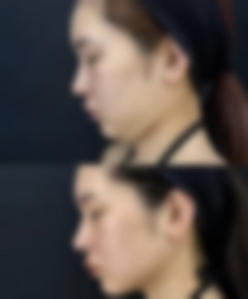 四、20多年的凹陷疤痕治疗实例分享