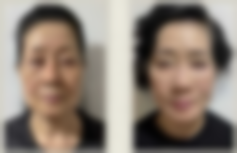 四、什么去手术疤痕更好之美观及护理提示