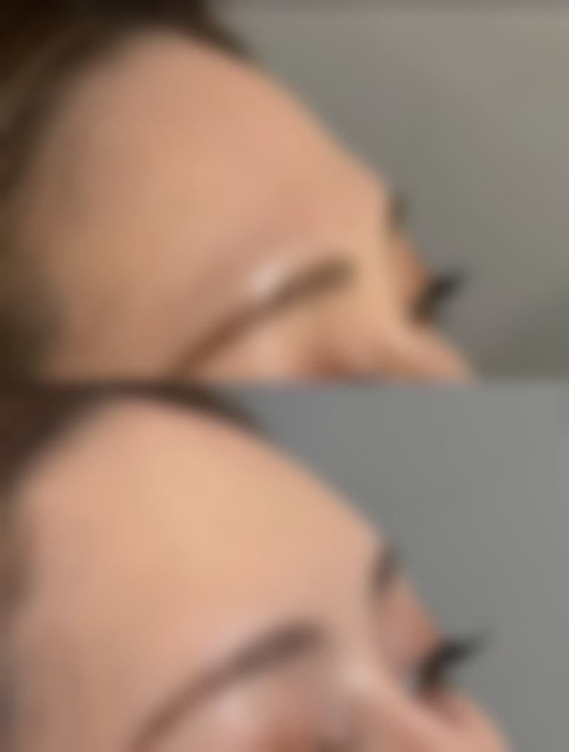 二、影响自体脂肪隆胸成效维持时间的关键因素