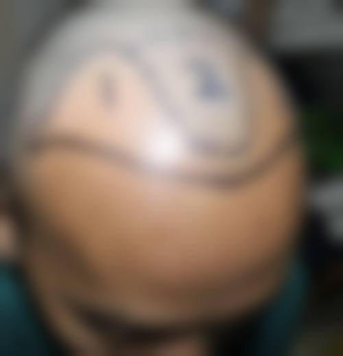 六、合肥大麦微针植发医院价格表