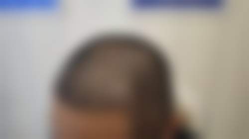 九、合肥大麦微针植发医院真实的患者评价