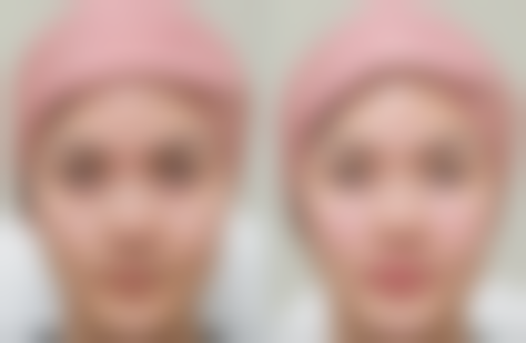 二、隆鼻手术半个月抽烟的其他危害