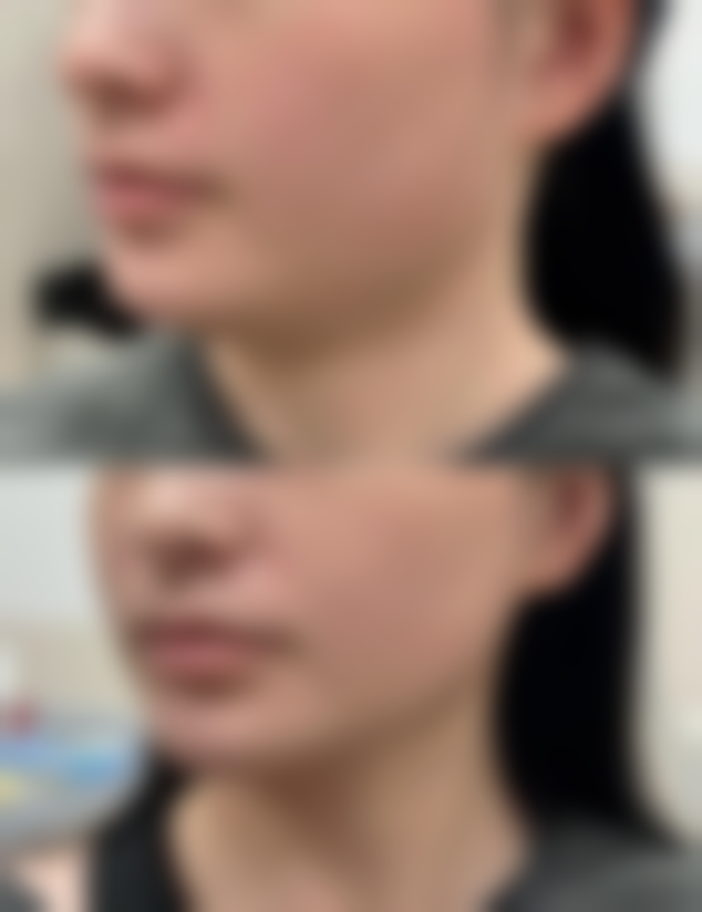 除皱针打一次能管多久？揭秘影响维持时间的因素及延长效果的实用方法 