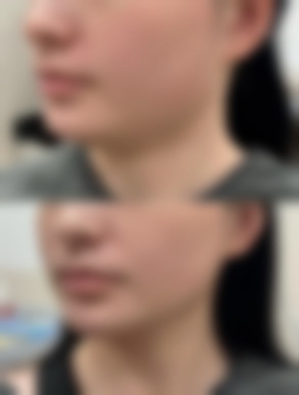 四、全切双眼皮增生修复的风险提示