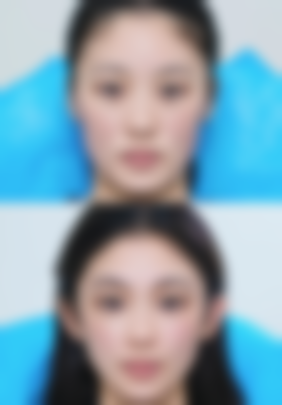 假体隆胸的肿胀期是多久？受这些因素影响，消肿时间差异竟这么大！ 