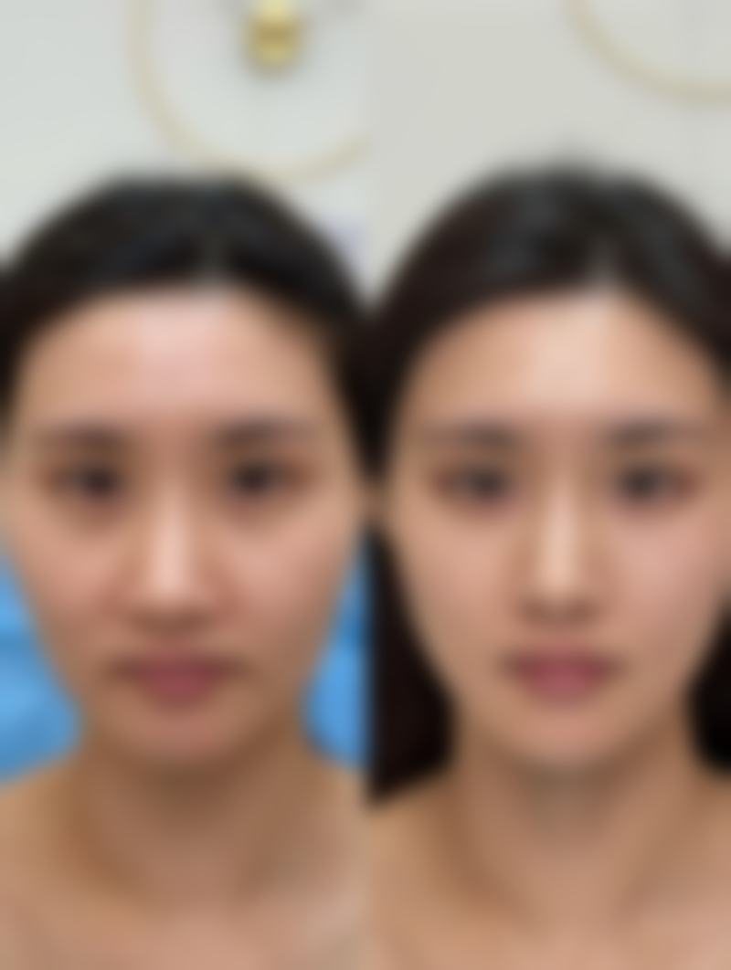 肋骨隆鼻后多久能运动健身？分阶段、按类型的运动恢复时间全揭秘！ 