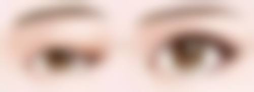 三、下眼袋发黑治疗的注意事项