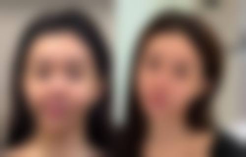 假体隆胸要多久才能恢复正常？影响恢复时间的因素及各阶段恢复详情揭秘