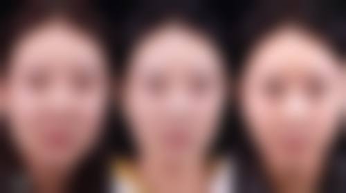 超声炮能改善眼袋吗？权威解析适用眼袋类型及效果，附真实案例视频揭秘！ 