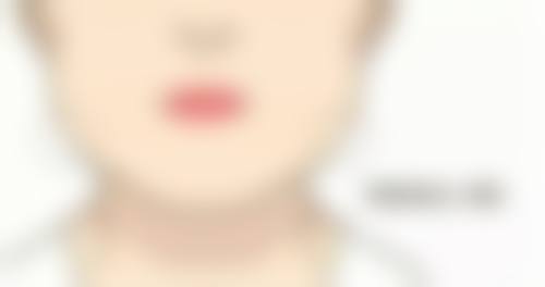 一、双眼皮开眼角和不开眼角在适合人群上的区别