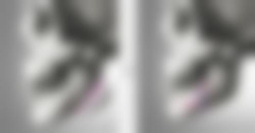 六、真实实例视频揭秘超声炮改善眼袋成效