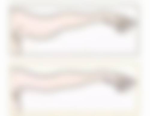 二、去眼袋手术方式与适用人群